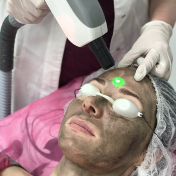 Лазерний карбоновий пілінг - делікатне очищення та покращенн