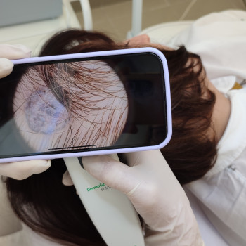 Дерматоскопія - апаратний метод діагностики шкірних новоутво