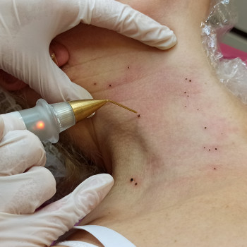 Лазерне видалення багаточисленних папілом в ділянці шиї.