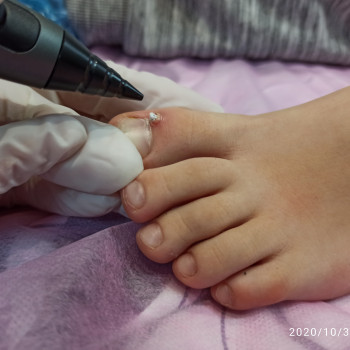 Видалення бородавок на сучасному кріодеструкторі Freezpen.