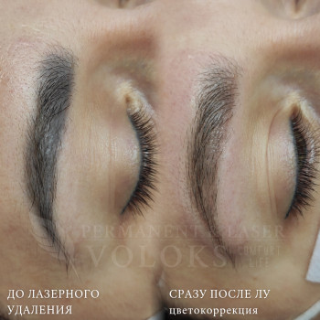 Удаление татуажа лазером (или ремувером)
                    Майстер перманентного макіяжу Оксана Київ