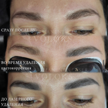 Удаление татуажа лазером (или ремувером)
                    Майстер перманентного макіяжу Оксана Київ