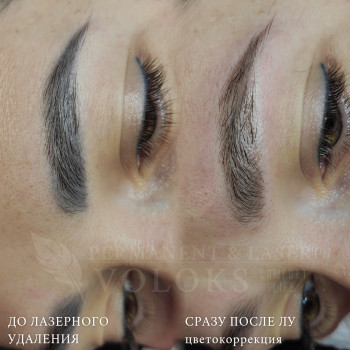 Удаление татуажа лазером (или ремувером)
                    Майстер перманентного макіяжу Оксана Київ