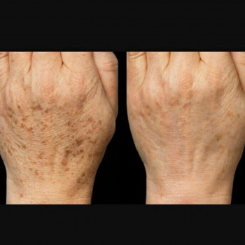 удаление пигментных пятен Произведен курс фототерапии