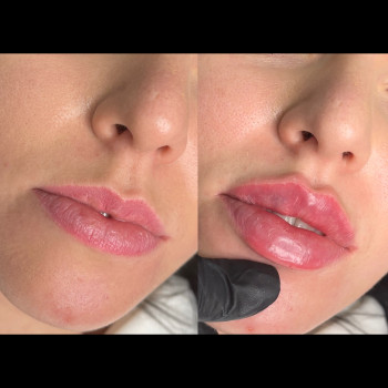 Увеличение губ
                    Косметолог Мария Киев