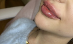 Увеличение губ Косметолог Мария Київ