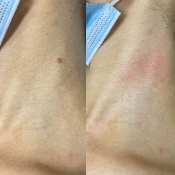 Лазерне видалення родимок в Ужгороді