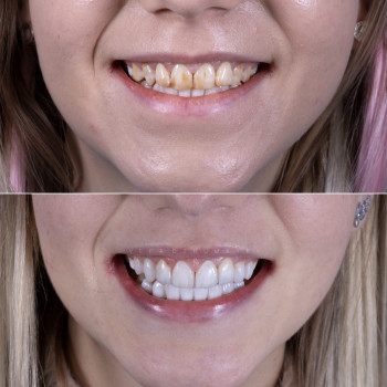 Композитні вініри, фото - стоматолог Вепа Джумаев