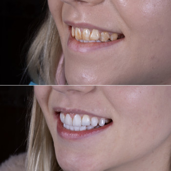 Композитні вініри, фото - стоматолог Вепа Джумаев