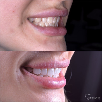 Керамічні вініри, фото - стоматолог Вепа Джумаев