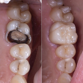 Відновлення безметалової коронкою зруйнованого зуба, фото - стоматолог Вепа Джумаев