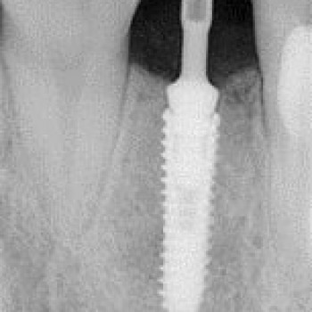 Імплантація, фото - стоматолог Вепа Джумаев