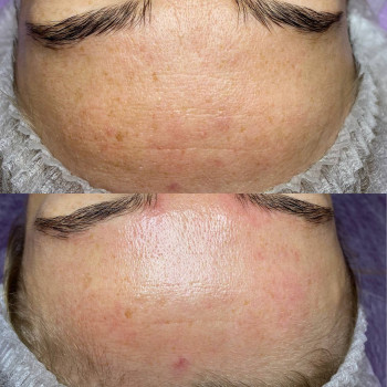 Результат 3-х процедур пилинга Kemikum.