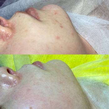 Результат 1й- процедуры пилинга Kemikum.