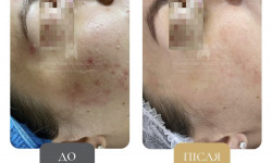 Лікування акне Clear Skin Косметологический центр Клініка естетичної медицини Мирослави Новосільської Ужгород