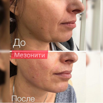 Мезонити
                    Косметолог Ирина Одеса