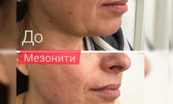 Мезонити Косметолог Ирина Одеса