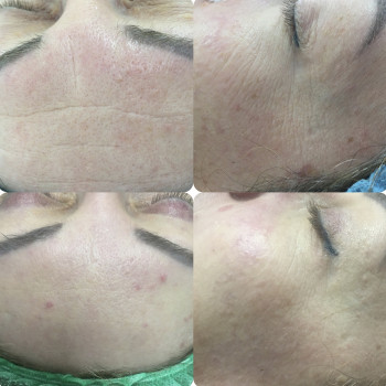 Работа с качеством кожи и морщинами