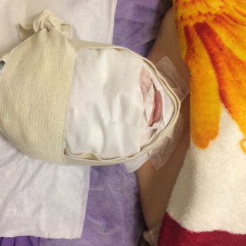 карбокситерапия брендаCocos-подходит всем и результат сразу 