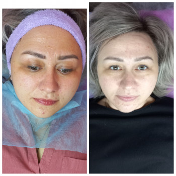 RF ліфтинг на апараті Zemits
                    Косметолог Лілія Винница