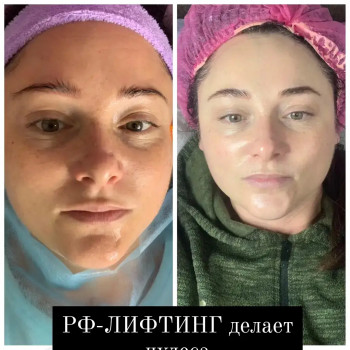 RF ліфтинг на апараті Zemits
                    Косметолог Лілія Винница