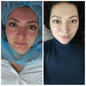 RF ліфтинг на апараті Zemits
                    Косметолог Лілія Винница