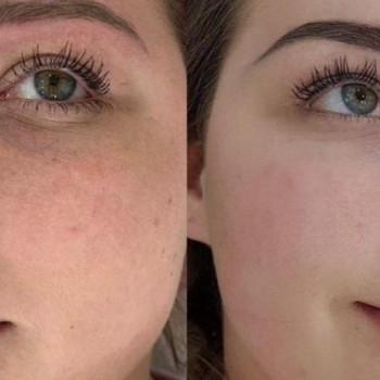 Процедура BB Glow Treatment
                    Лікар-косметолог Юлия Харків