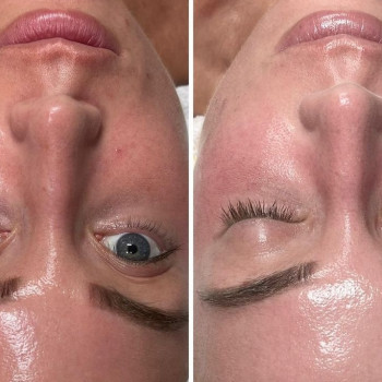 Процедура BB Glow Treatment
                    Лікар-косметолог Юлия Харків