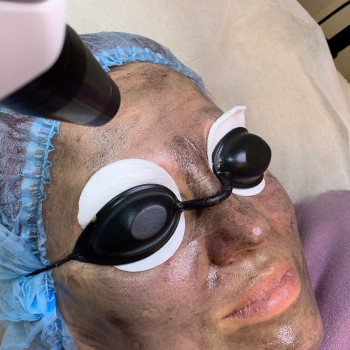 Карбоновый пилинг
                    Мастер перманентного макияжа Виктория Киев