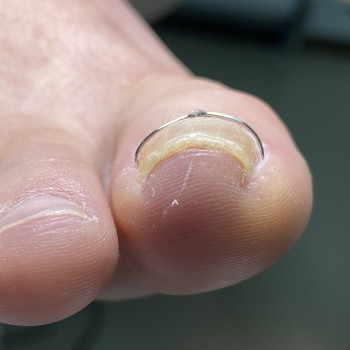 Скоба Росса Фрезера
                    Подолог Лілія Черкаси