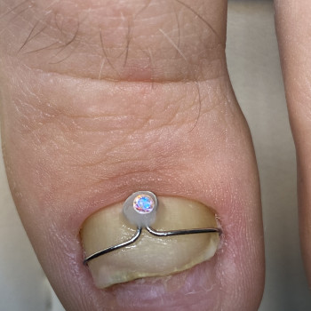 Скоба Росса Фрезера
                    Подолог Лілія Черкаси