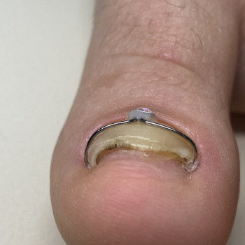 Скоба Росса Фрезера
                    Подолог Лілія Черкаси