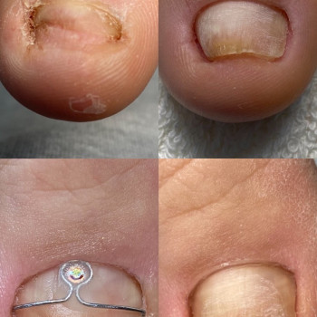 Скоба Росса Фрезера
                    Подолог Лілія Черкаси