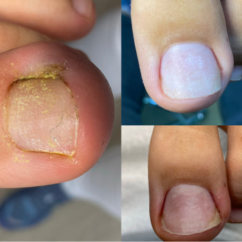 Скоба Росса Фрезера
                    Подолог Лілія Черкаси