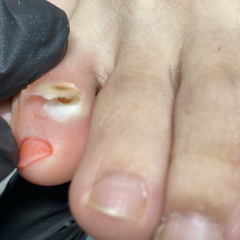 Видалення стержневої мозолі
                    Подолог Лілія Черкассы