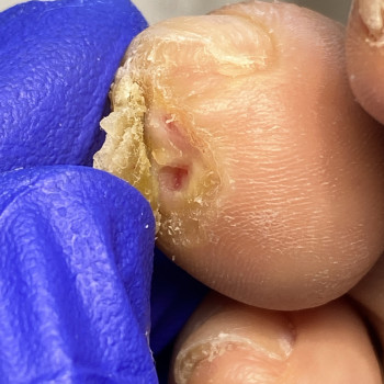 Видалення стержневої мозолі
                    Подолог Лілія Черкассы