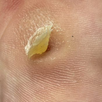 Видалення стержневої мозолі
                    Подолог Лілія Черкассы