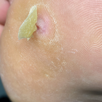 Видалення стержневої мозолі
                    Подолог Лілія Черкассы