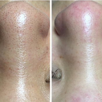 Механическая чистка