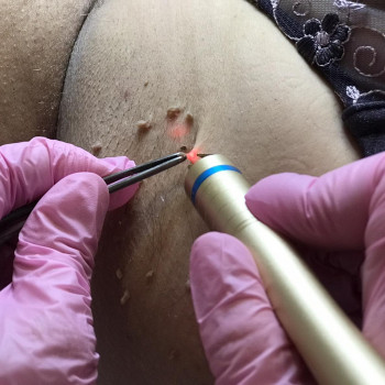 лазерне видалення папілом в пахвинній ділянці.