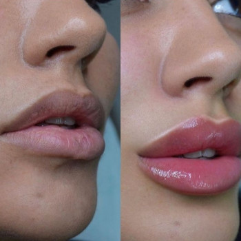 Увеличение губ (cертифицированный препарат)
                    Косметолог-ін'єкціоніст Наталия Одеса