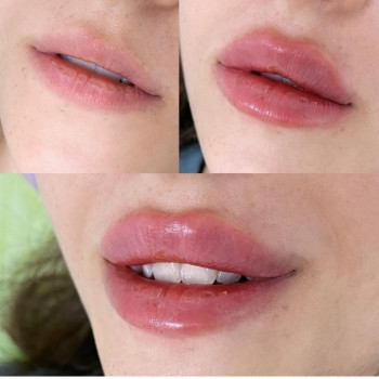 Увеличение губ (cертифицированный препарат)
                    Косметолог-ін'єкціоніст Наталия Одеса