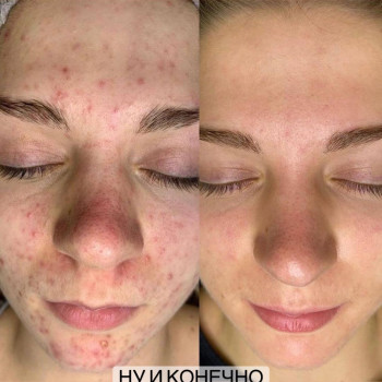 Перманентный макияж
                    Майстер перманентного макіяжу Ангелина Вінниця