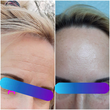 Безинъекционная методика