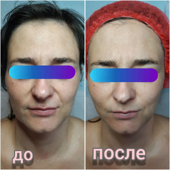 Рф лифтиг 3 процедуры