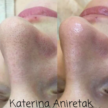 Комби чистка