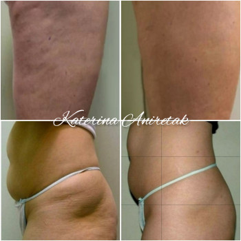 Кавитация + вакуумный массаж