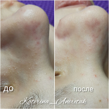 Комби чистка