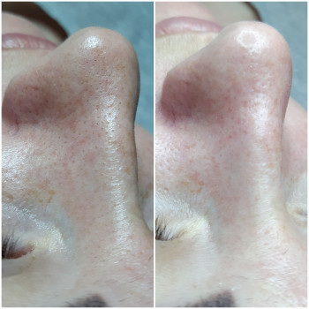 Чистка лица