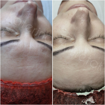 Программа омоложения